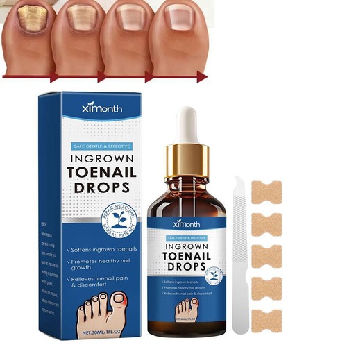 30ml ingrown toenail - 30ml,