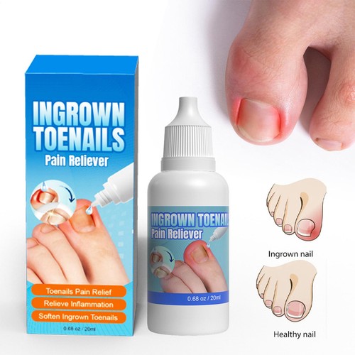 Ingrown toenail drops - ingrown,